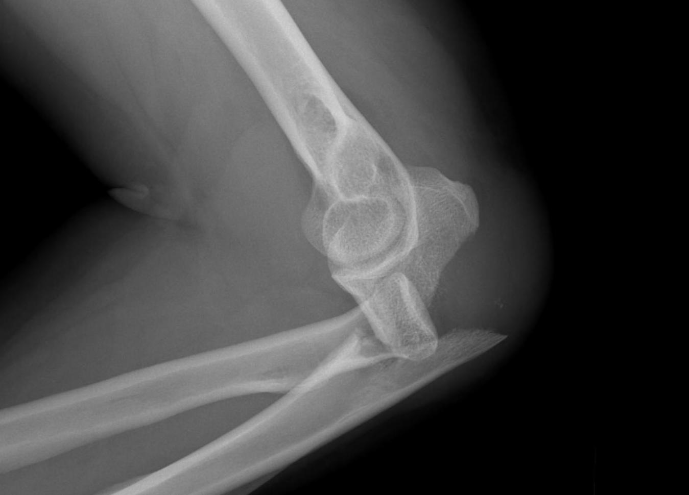 Elbow Monteggia Fracture